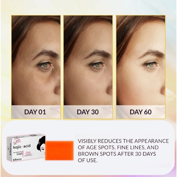 kojic acid days result Kilarca Kojic Acid Skin Lightening Soap – Quick Whitening & Pigmentation Removal (120g) - Image 3
